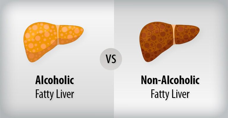 5 Gejala Awal Hati Berlemak Non Alkohol yang Perlu Diwaspadai