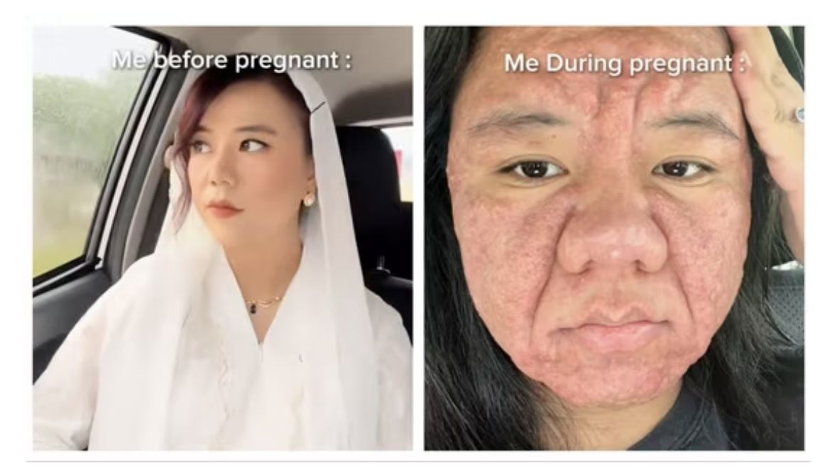 Viral! Wajah Wanita Cantik Ini Berubah Jadi Bengap Usai Hamil, Diduga Alami Kondisi Kulit Langka