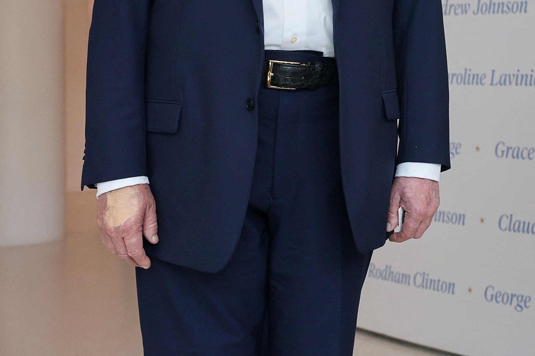Penjelasan Medis di Balik Memar Tangan Donald Trump yang Bikin Publik Cemas