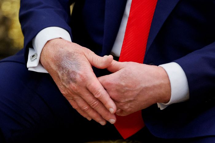 Penjelasan Medis di Balik Memar Tangan Donald Trump yang Bikin Publik Cemas