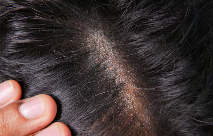 Gak Melulu Ketombe, Bisa Jadi Serpihan Kulit Kepala di Rambut Itu Psoriasis! Berikut 4 Tanda Utama