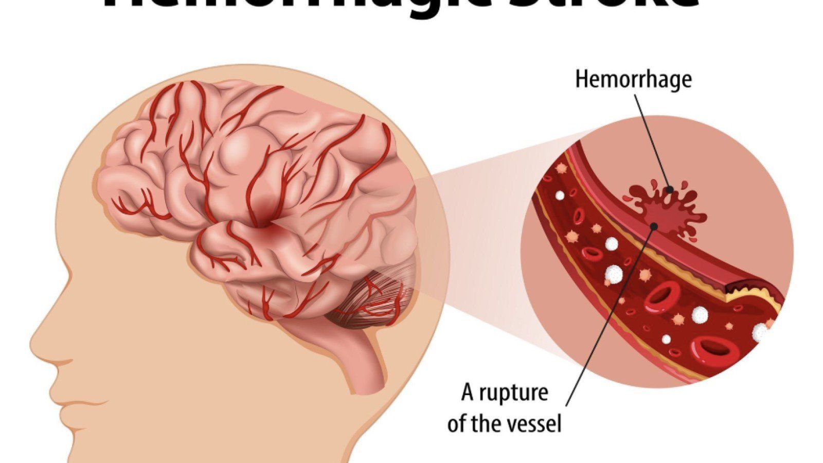 Mengenal Gejala Stroke dan Pentingnya Penanganan Cepat