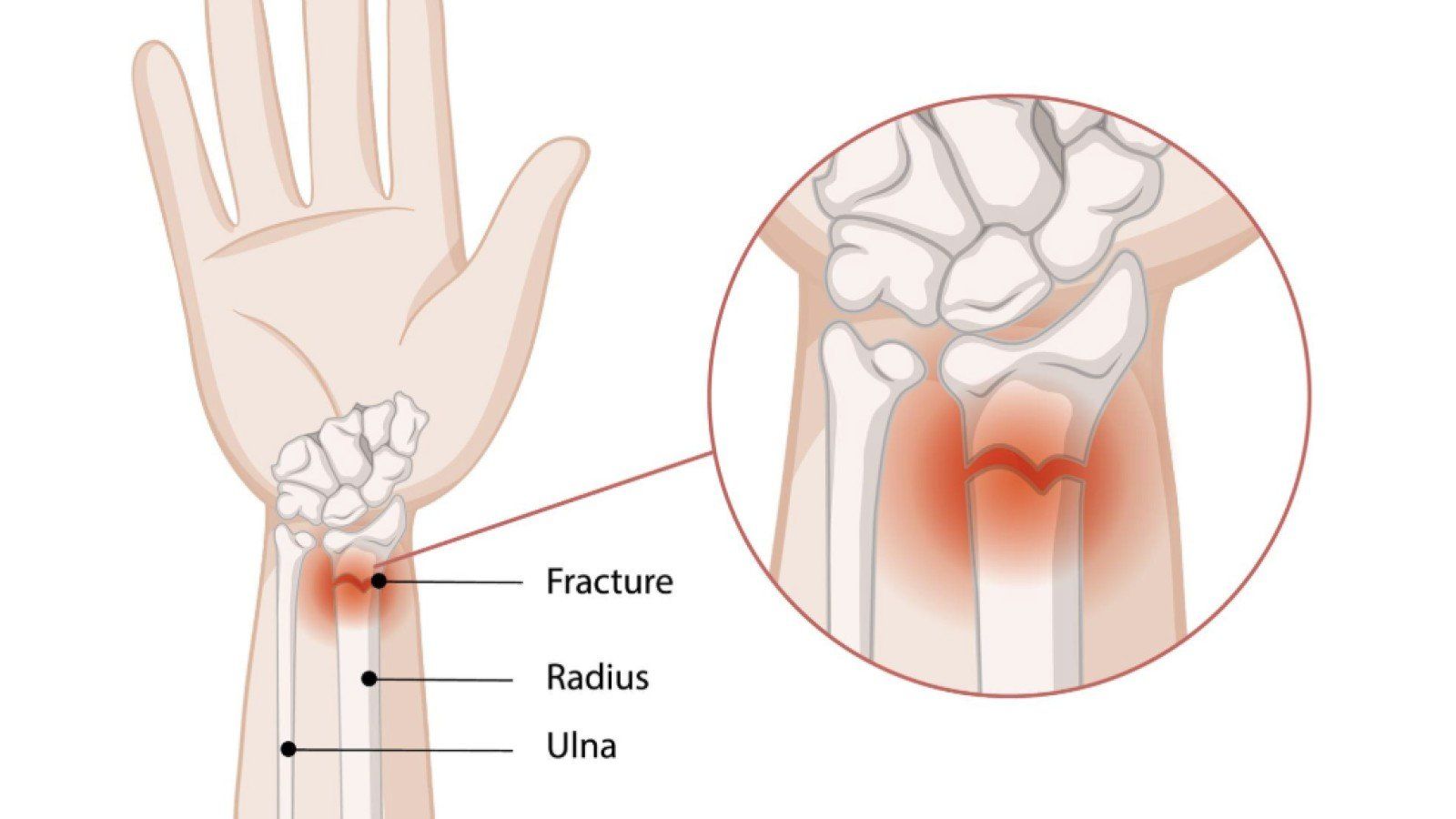 Osteopenia: Ketahui Penyebab dan Pentingnya Pendeteksian Dini