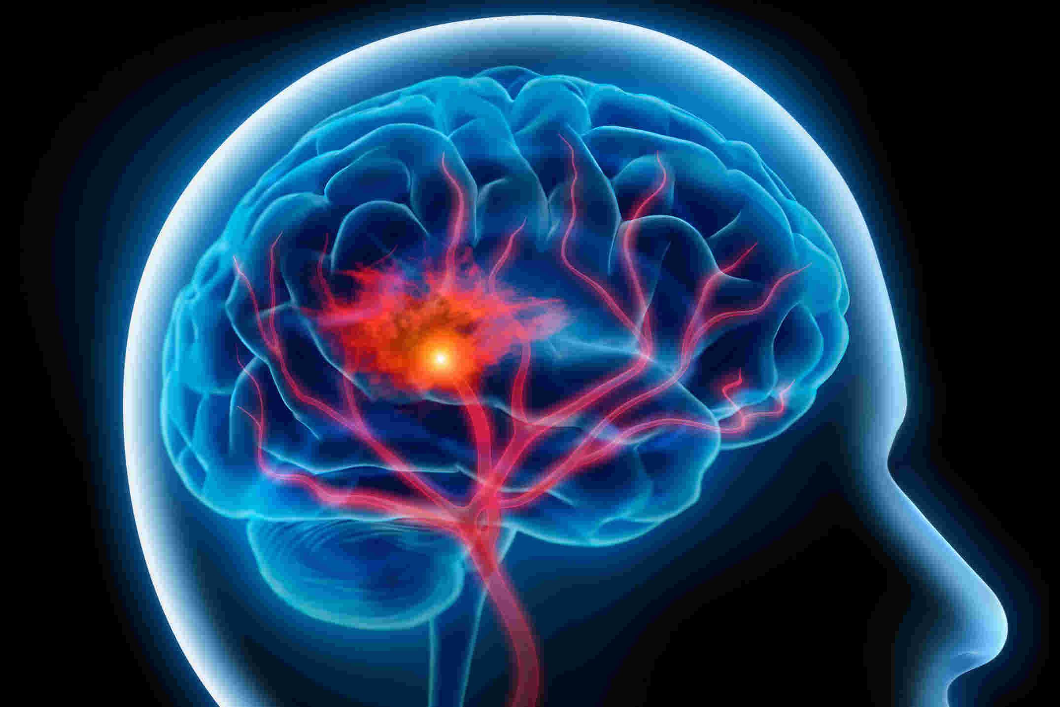 Bahaya Silent Stroke, Ancaman Serius yang Tak Terlihat