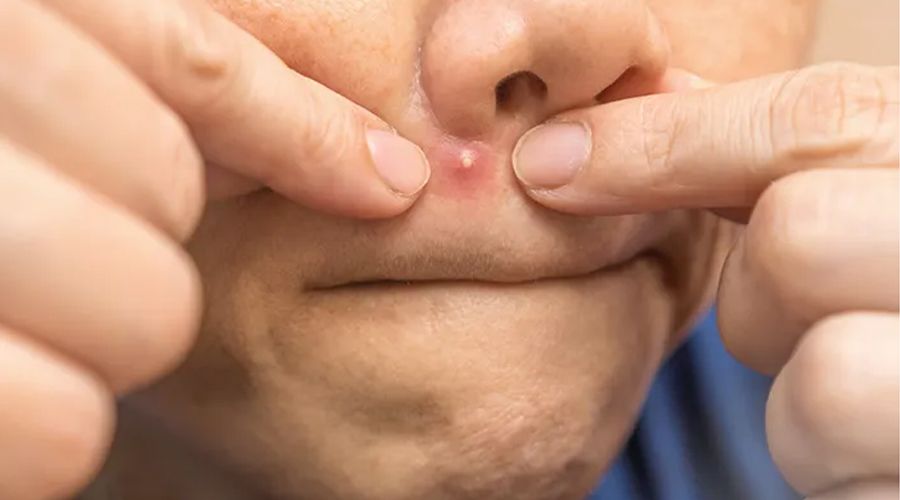 Begini Cara Mengatasi Jerawat Tanpa Obat Kimia