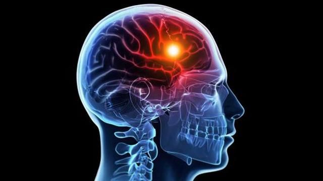 Mitos Medis: Stroke Bukan Sekadar Penyakit Orang Tua, Ini Fakta Sebenarnya