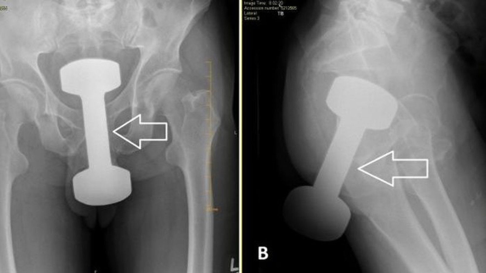 Kasus Unik: Dokter di Pennsylvania Berhasil Mengeluarkan Dumbell dari Rektum