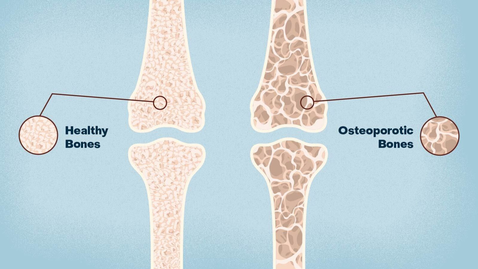 Osteoporosis pada Pria: Risiko dan Pentingnya Kesadaran Kesehatan Tulang