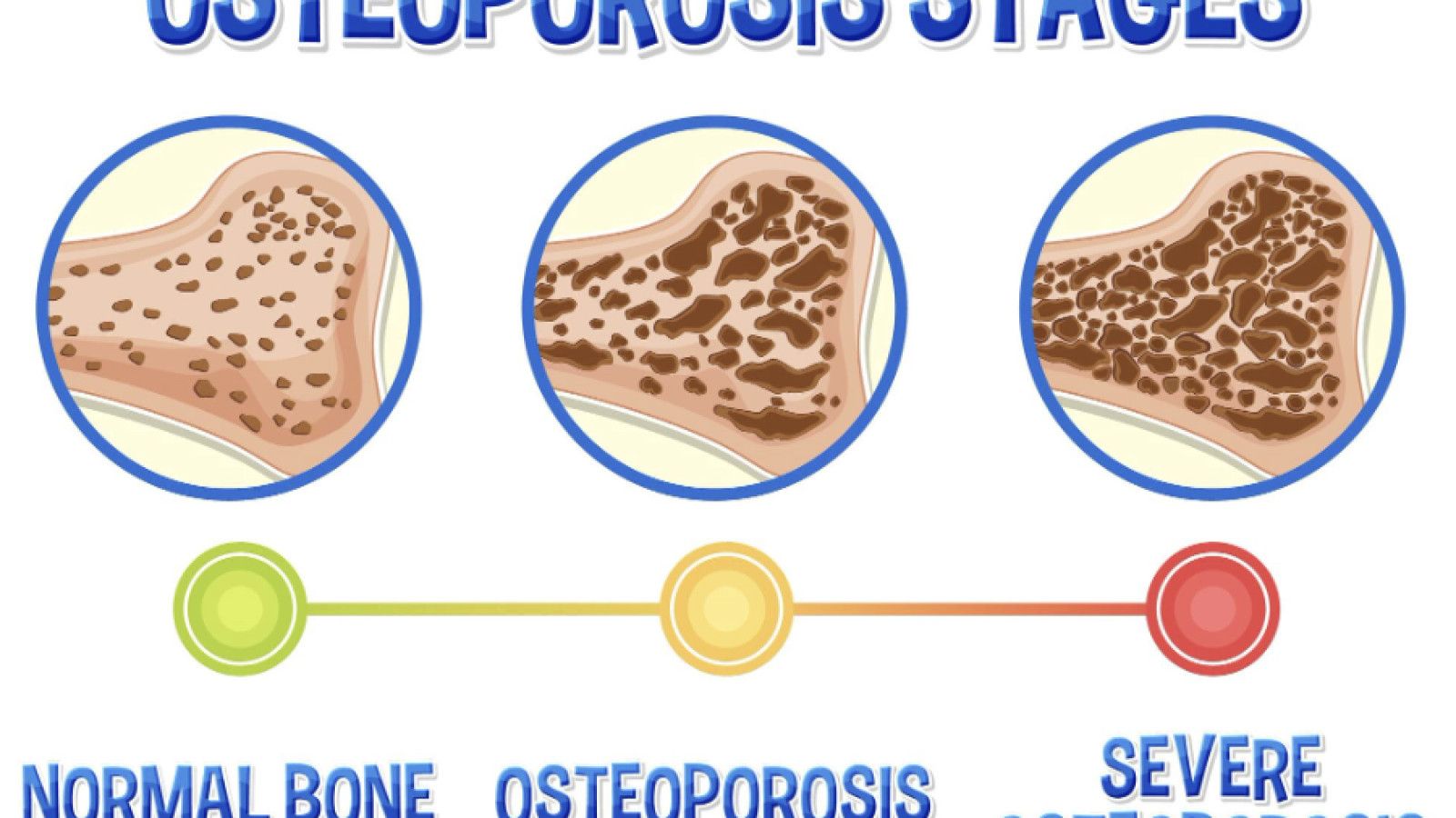 Pentingnya Kesadaran tentang Osteoporosis di Indonesia