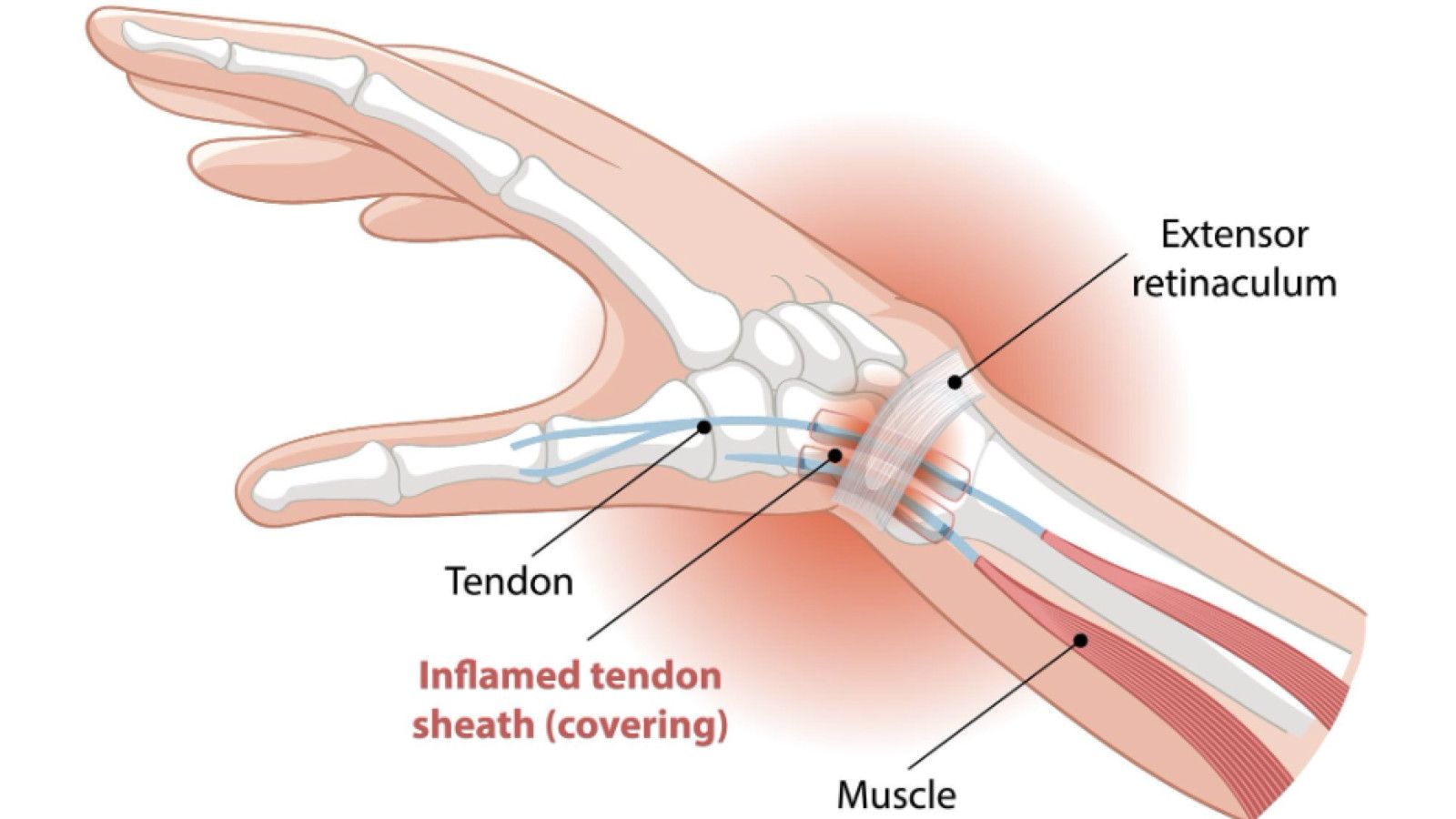 Memahami Gout Arthritis dan Rematik: Apa Bedanya?
