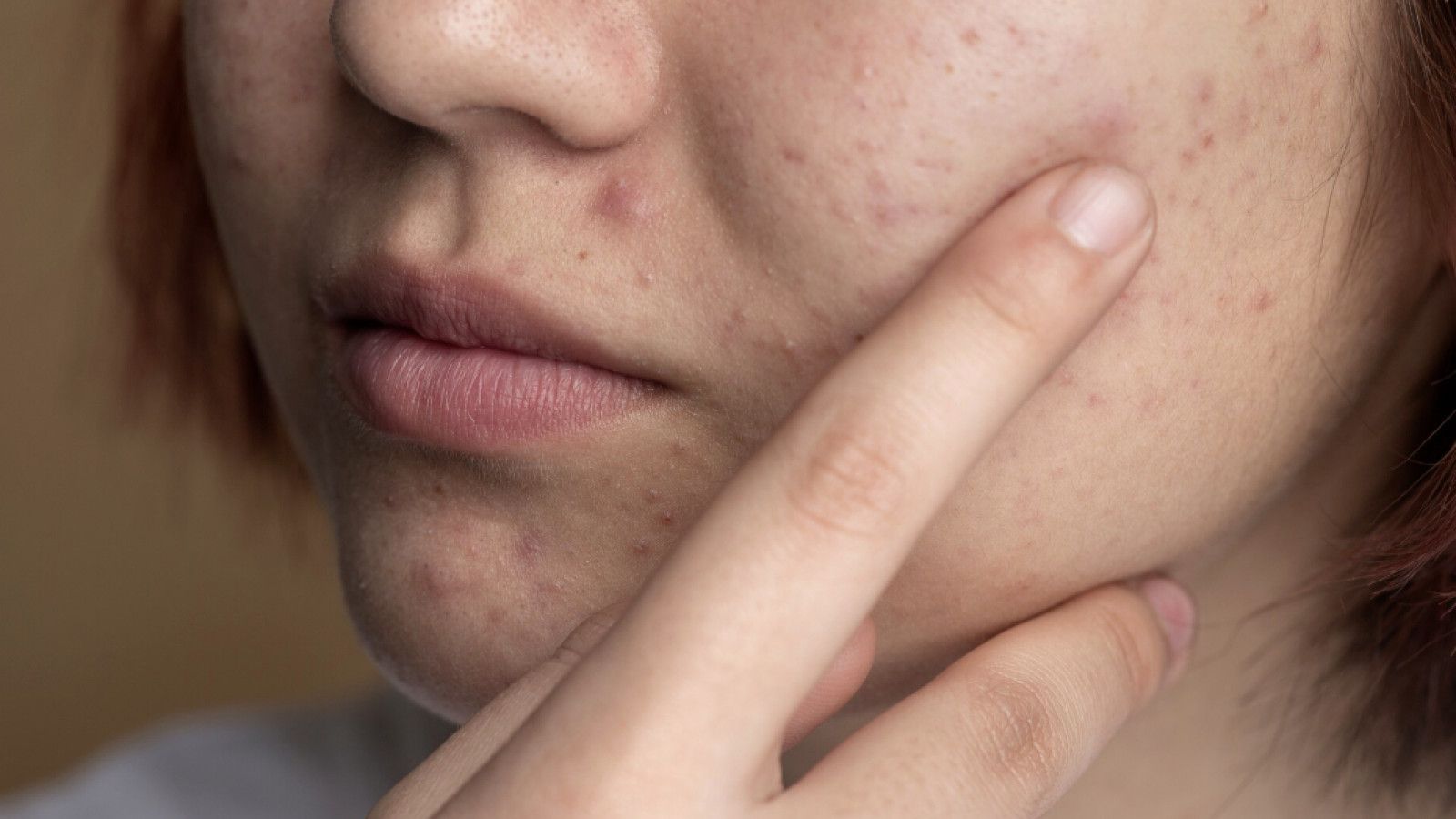 Mengatasi Jerawat dengan Bahan Alami: Solusi Efektif untuk Kulit Berjerawat