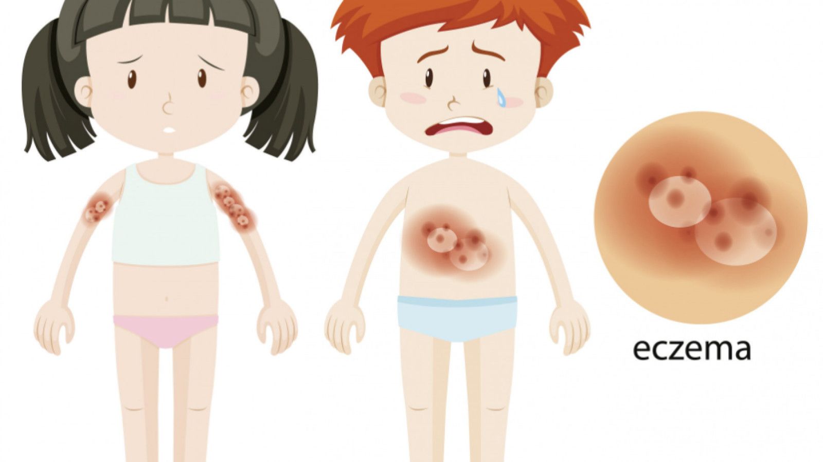 Mengenal Cacar Air: Penyakit Menular yang Umum hingga Gejalanya