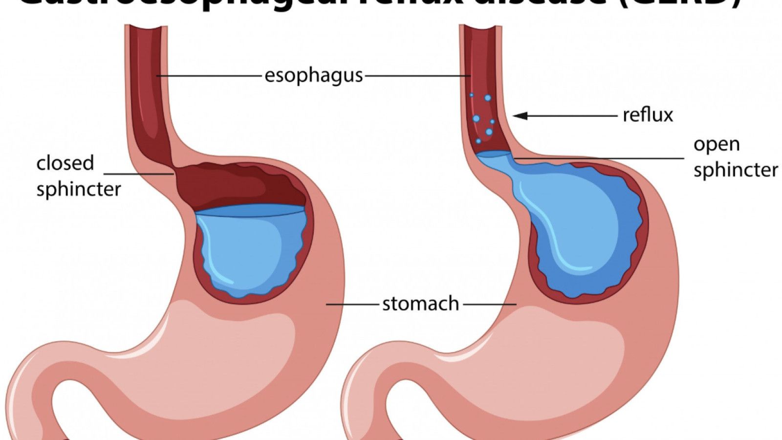 Pentingnya Memahami dan Mengatasi Gastroesophageal Reflux Disease (GERD)