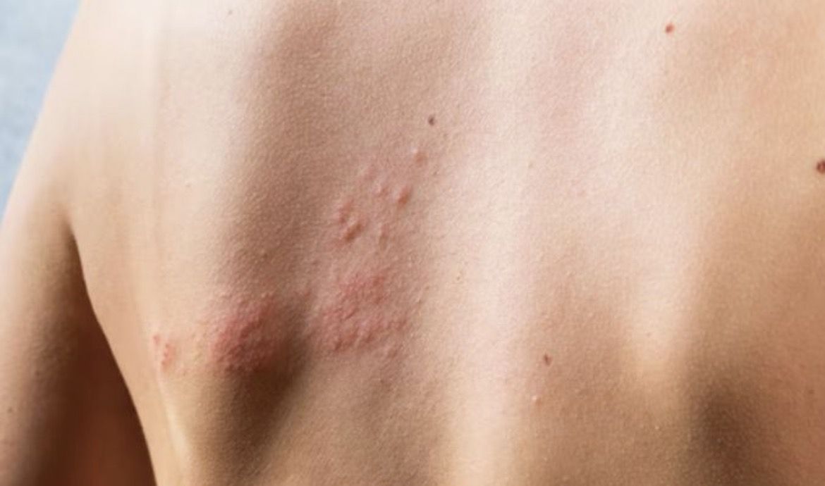 Jangan Anggap Remeh! Ini 6 Fakta Penting Herpes Genital yang Jarang Diketahui