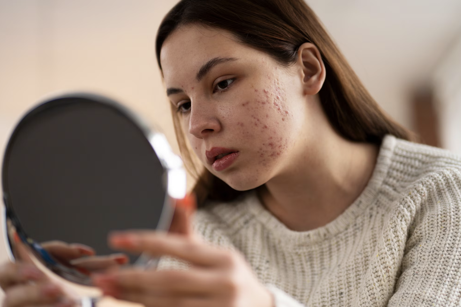 Jerawat dan Breakout Nggak Kunjung Sembuh? Mungkin Kulitmu Diserang Fungal Acne!