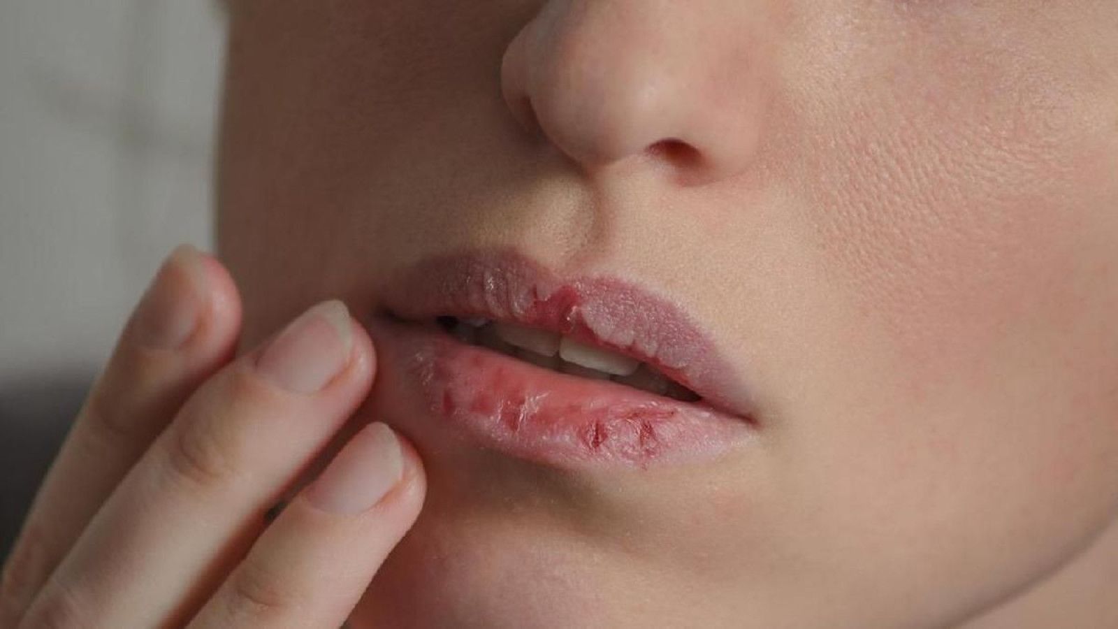 Kondisi Mulut Kering: Tanda Bahaya bagi Kesehatan Sistemik