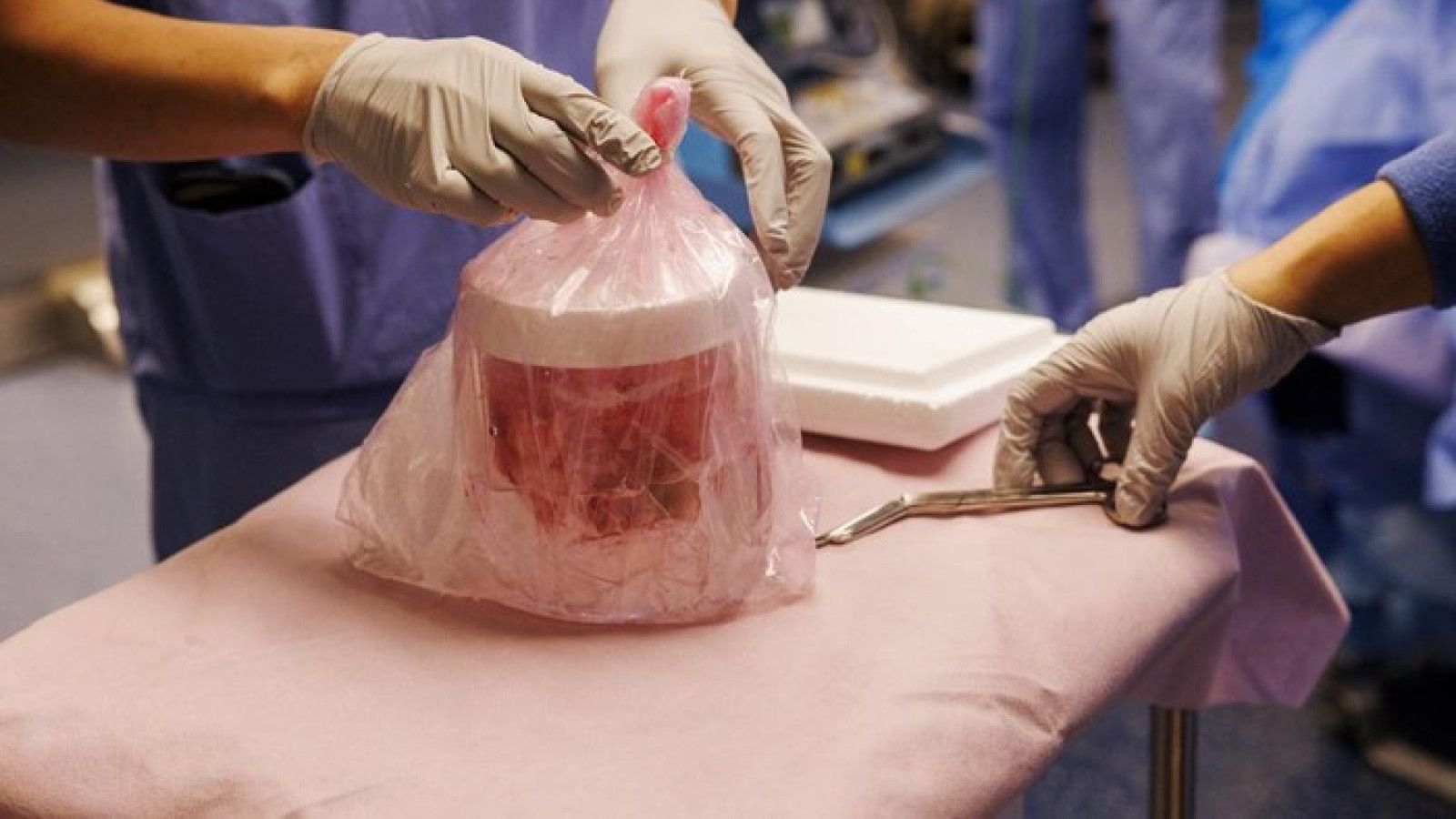 Kemajuan Transplantasi Ginjal Babi untuk Pasien Manusia di NYU Langone Health