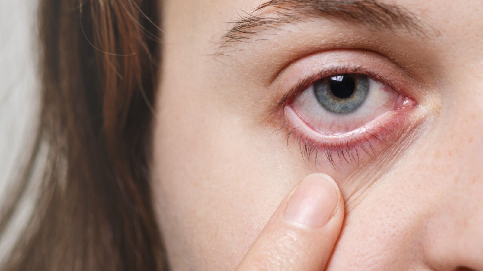 Pemahaman Mendalam tentang Pterygium: Gangguan Mata yang Dapat Dihindari