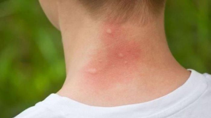 8 Cara Ampuh Menghilangkan Bekas Gigitan Nyamuk, Wajib Tau!