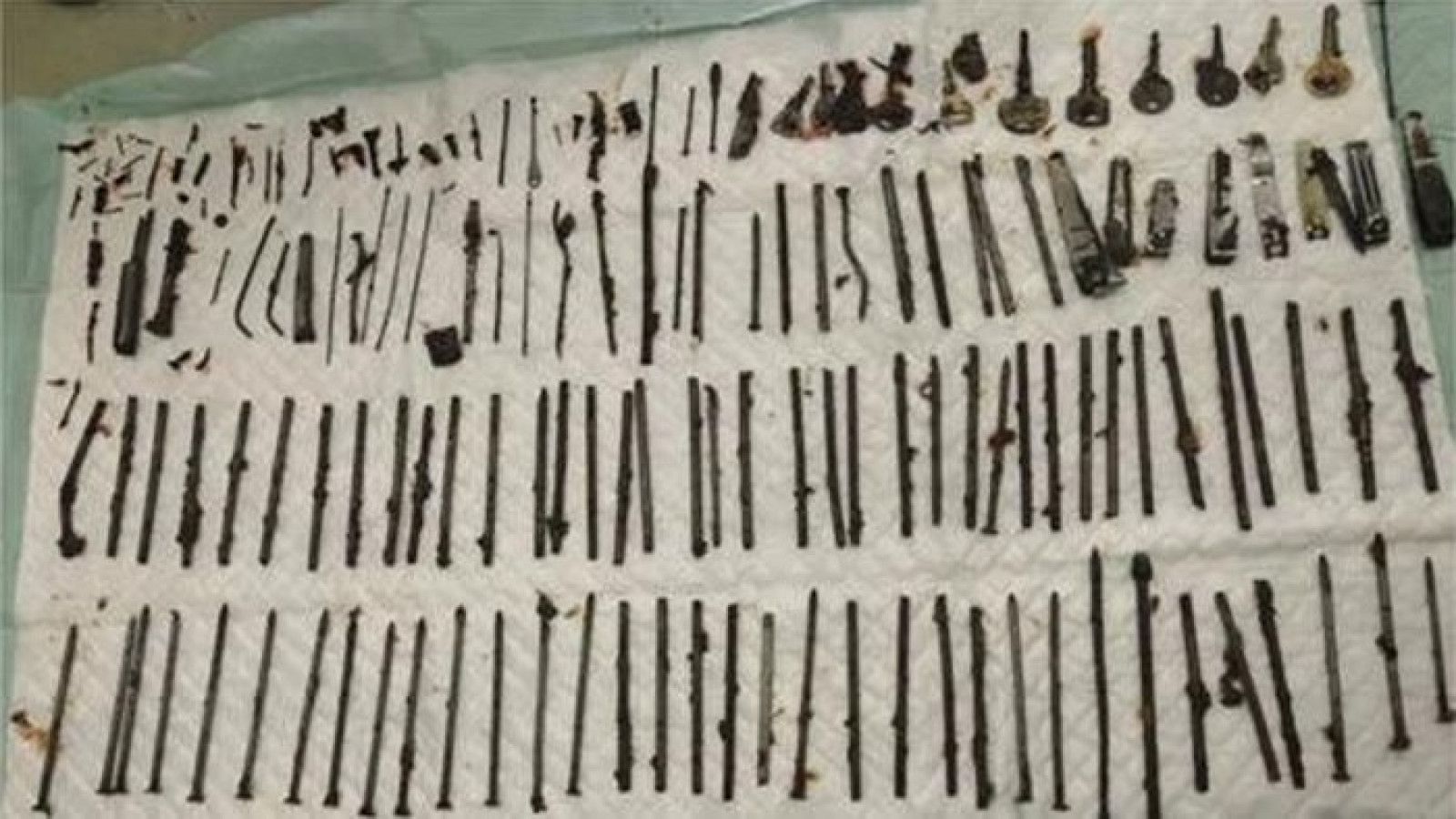 Penemuan Mengejutkan: 120 Benda Asing Ditemukan dalam Perut Seorang Pasien di China