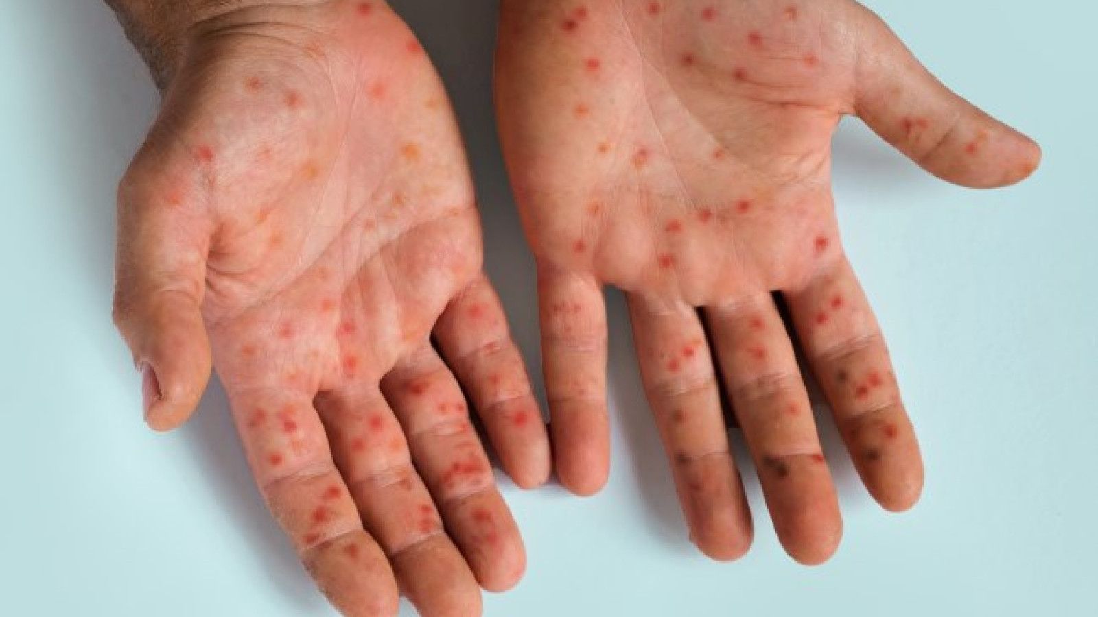 Penemuan Strain Baru Virus Mpox: Apa yang Perlu Diketahui?
