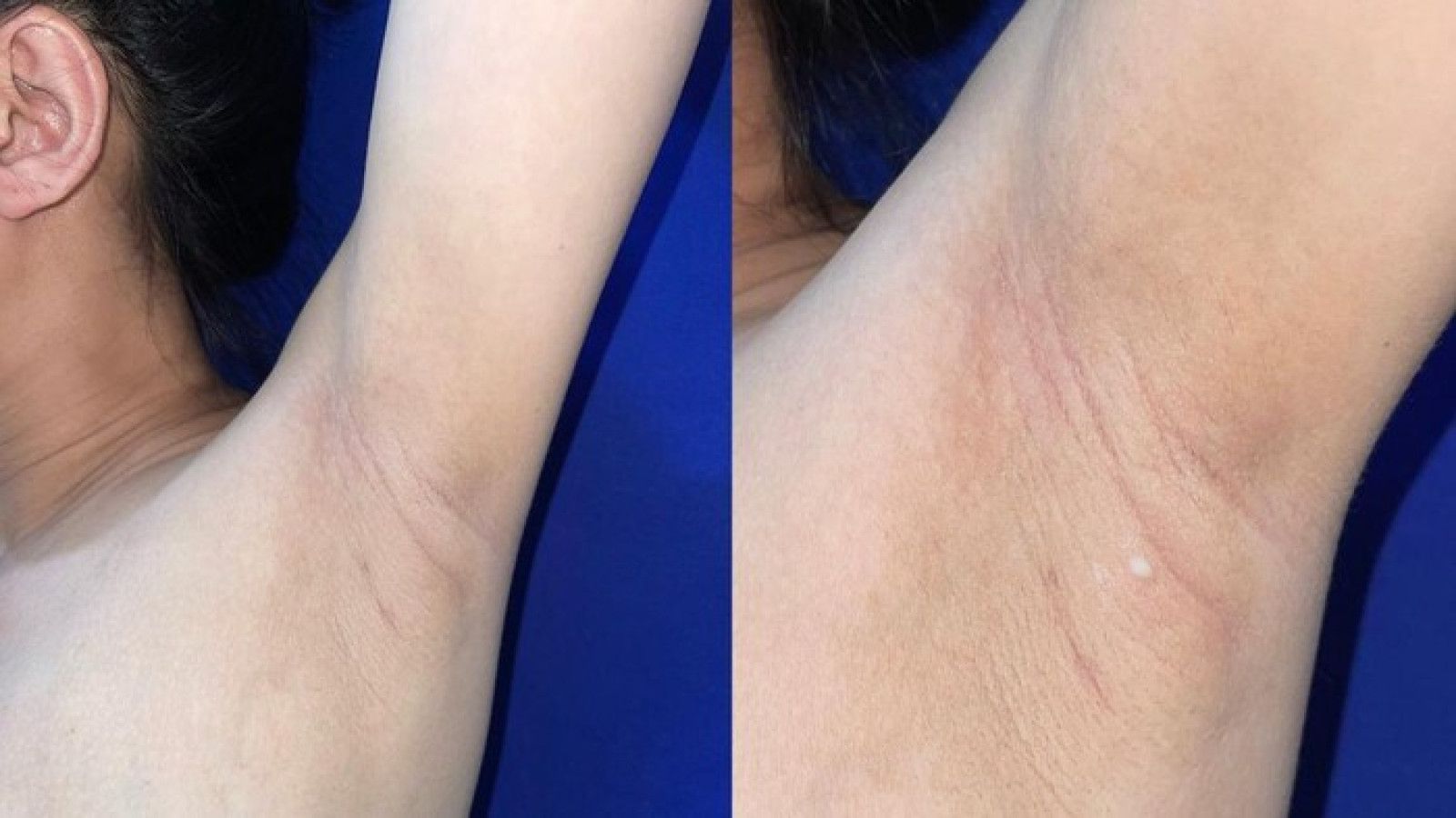 Fenomena Mammae Aberans: Air Susu Ibu dari Ketiak