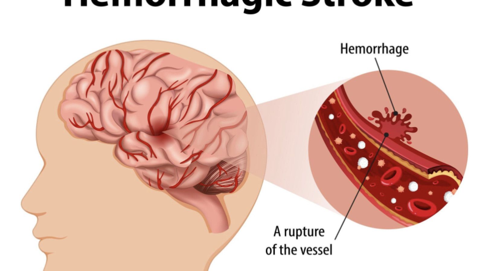Mencegah Stroke melalui Perubahan Gaya Hidup