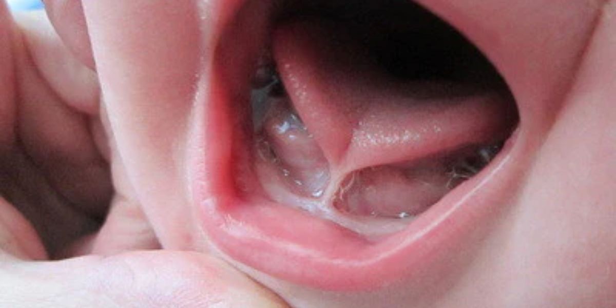 Tongue Tie pada Bayi: Ciri-Ciri, Cara Mengecek, Dampak Menyusui, hingga Biaya Operasi