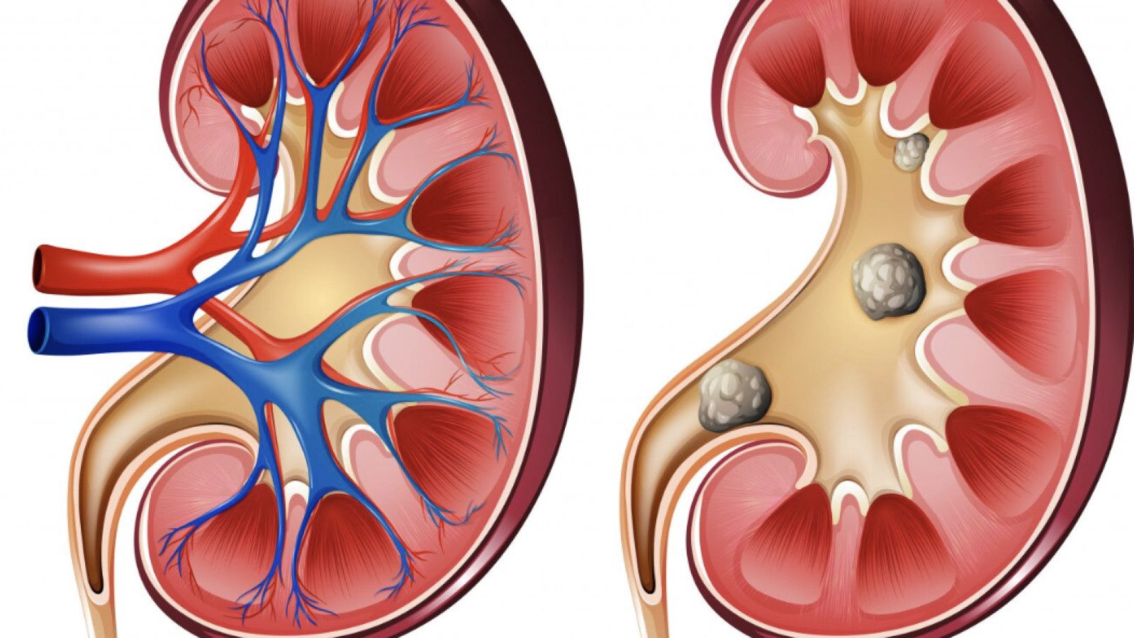 Memahami Gejala dan Penanganan Batu Ginjal Secara Medis
