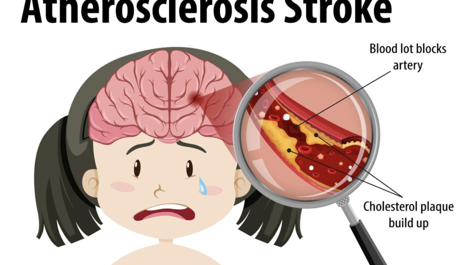Memahami Stroke: Faktor, Tanda, dan Langkah Pertolongan Pertama