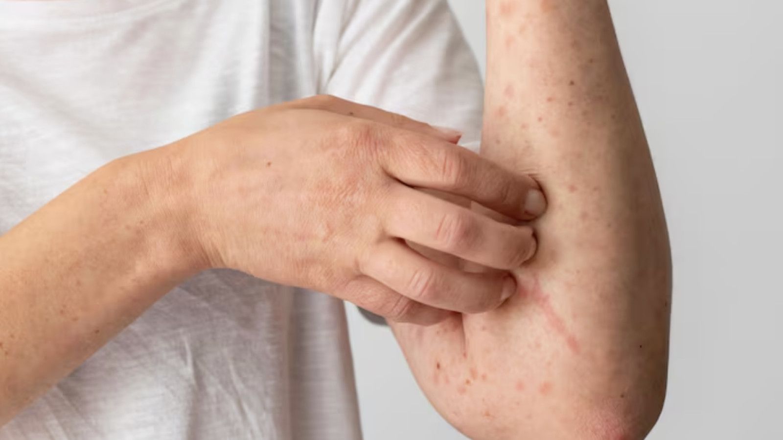Menemukan Antihistamin yang Tepat untuk Gatal Akibat Alergi