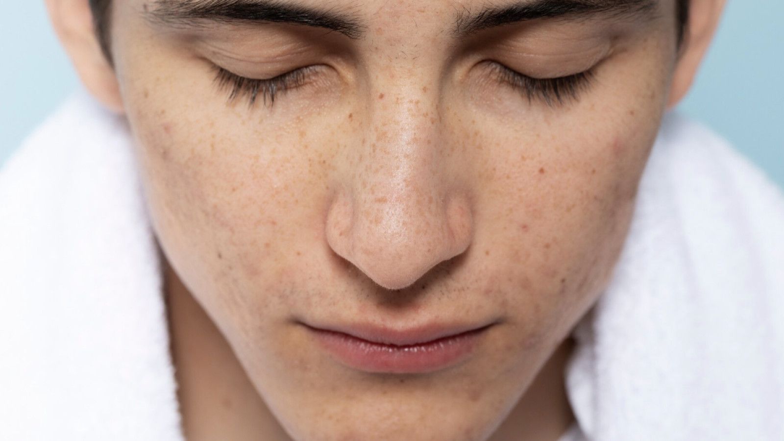 Vitamin C atau Retinol: Mana yang Lebih Efektif untuk Mengatasi Bekas Jerawat?