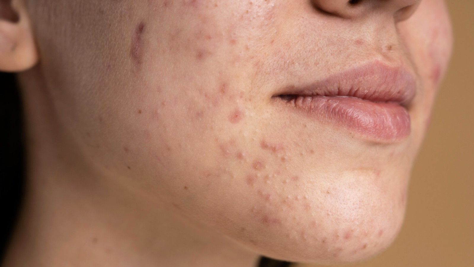 Mengenal dan Mengatasi Fungal Acne: Tanda-Tanda serta Produk yang Harus Dihindari