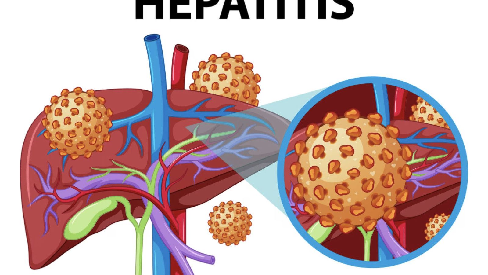 Mengenal Hepatitis A: Gejala, Pengobatan, dan Langkah Pencegahan yang Efektif
