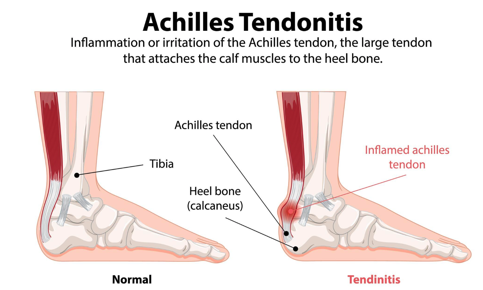 Memahami Tendinitis Achilles: Cedera pada Tumit yang Sering Dialami Pelari dan Olahragawan