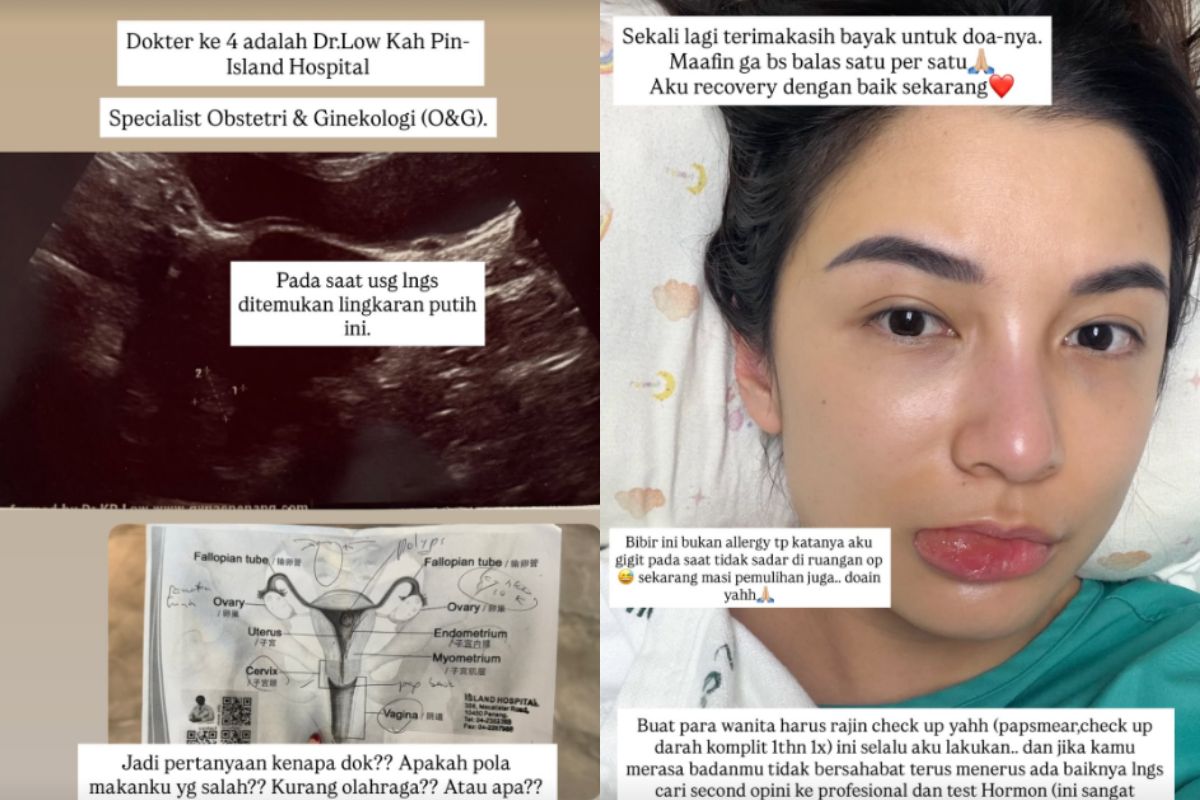 Alami Pendarahan hingga Jalani Empat Prosedur Operasi Sekaligus, Chelsea Olivia Sakit Apa?