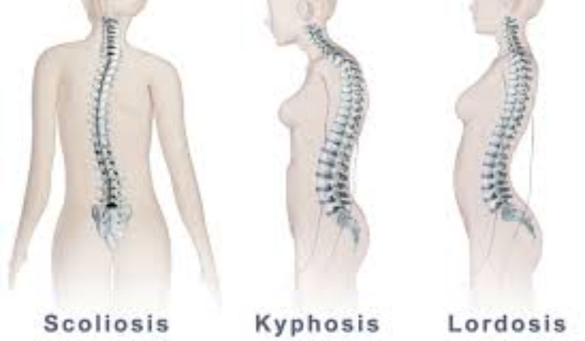Kesulitan Membedakan Lordosis, Kifosis, dan Skoliosis? Ini Penjelasan Lengkapnya