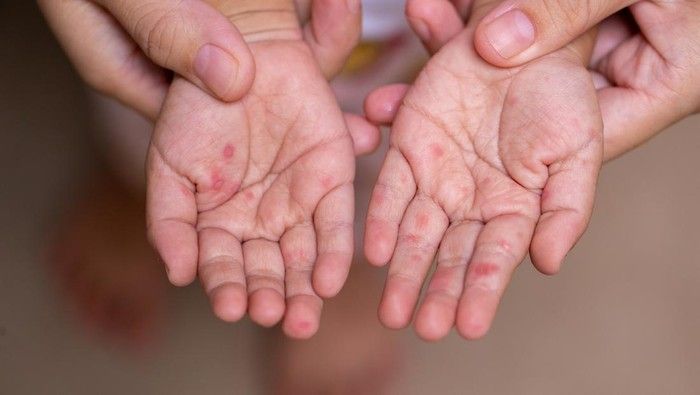 Kasus Campak Meningkat Jelang Mudik Lebaran 2026, Pakar UGM Minta Warga Waspada : Ini Alarm