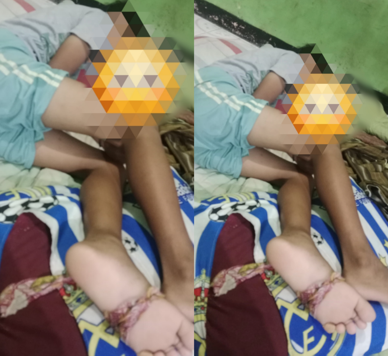 Tak Ada Tenaga Medis Anak Tersengat Ikan Beracun di Pulau Tunda Kab. Serang Hanya Meringkuk Menahan Sakit