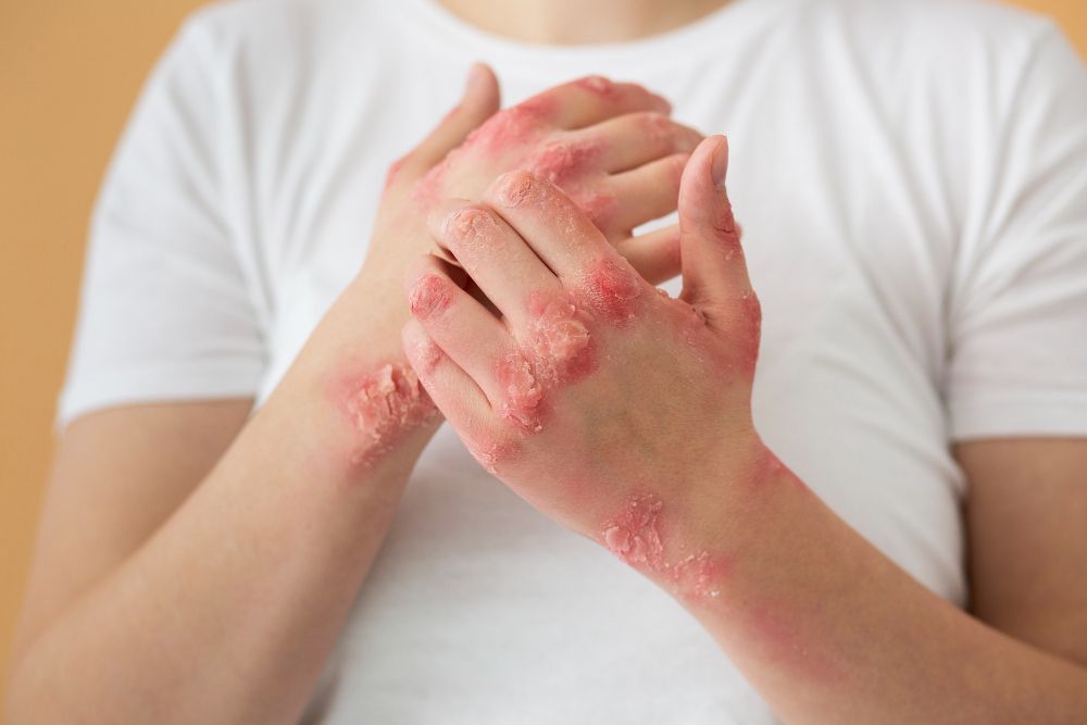 Obat Alami untuk Herpes yang Aman dan Mudah Digunakan, Bisa Bantu Redakan Gejalanya