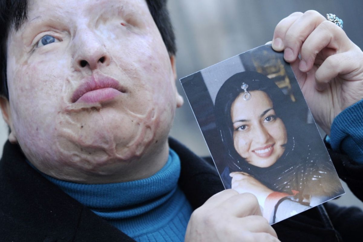 Kisah Ameneh Bahrami Wanita yang Disiram Air Keras Usai Menolak Lamaran Pria