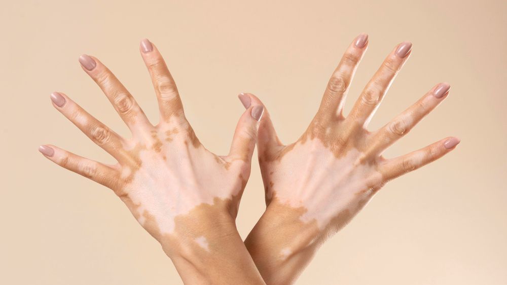 Apakah Vitiligo Bisa Sembuh atau Hanya Dikontrol? Ini Faktanya