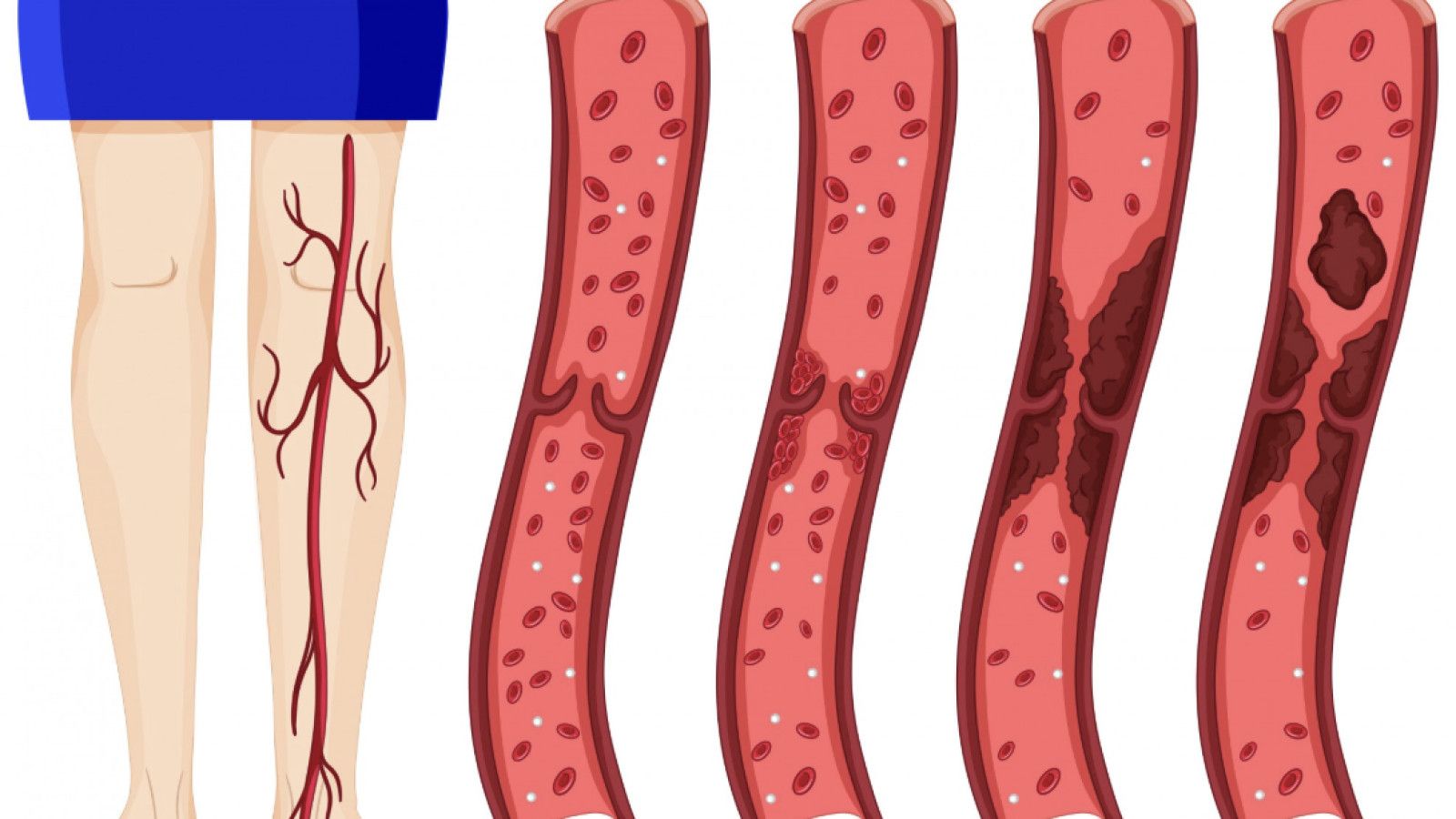 Mengenal Penyakit Arteri Perifer: Bahaya Tersembunyi pada Kesehatan Kaki
