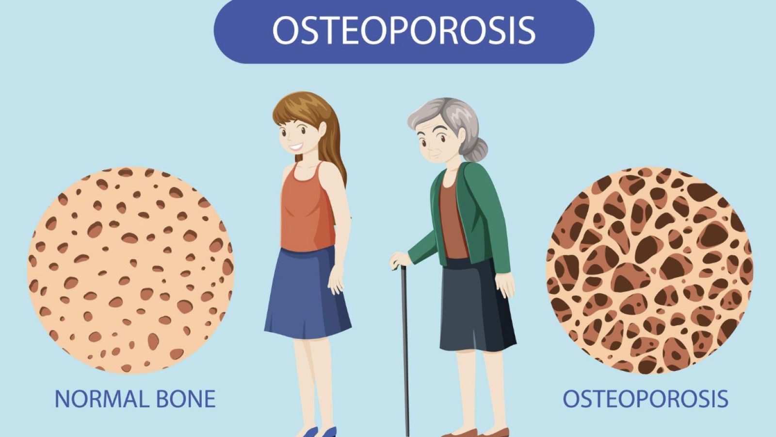 Memahami Pentingnya Deteksi Dini Osteoporosis pada Wanita