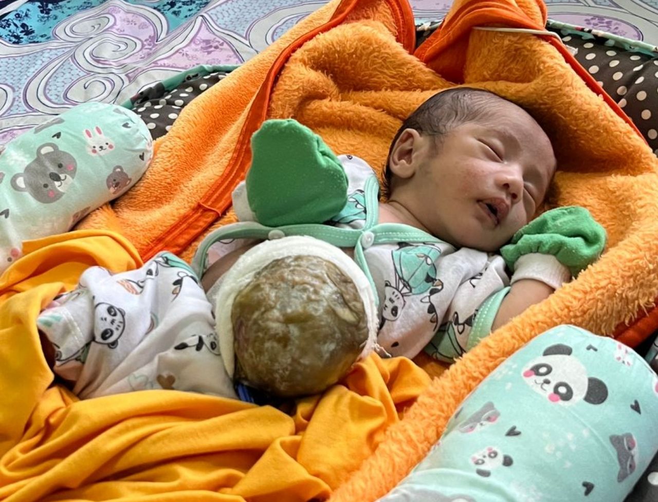 Bayi di Pandeglang Alami Kelainan Usus Langka, Keluarga Buruh Gembala Kambing Butuh Uluran Tangan