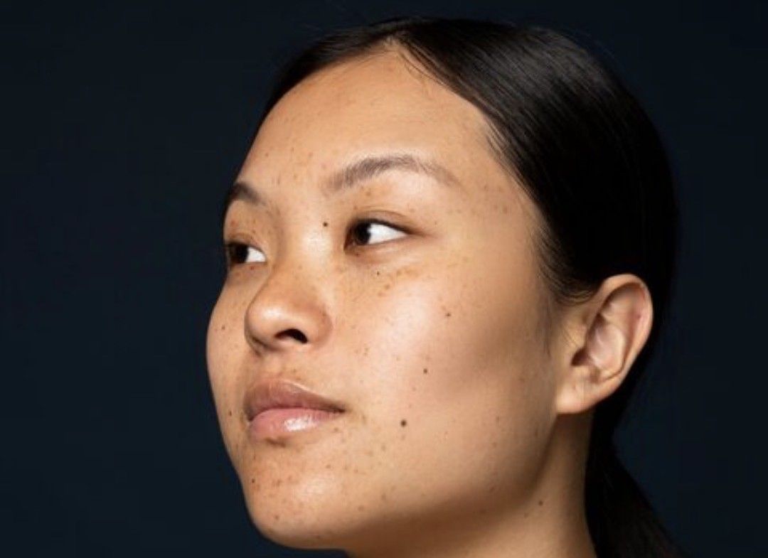 Perempuan Indonesia Rentan Alami Melasma, Flek di Wajah yang Sulit Hilang