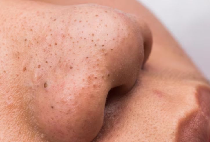 Simak Cara Aman Hilangkan Komedo Hitam di Hidung, Jangan Dipencet!