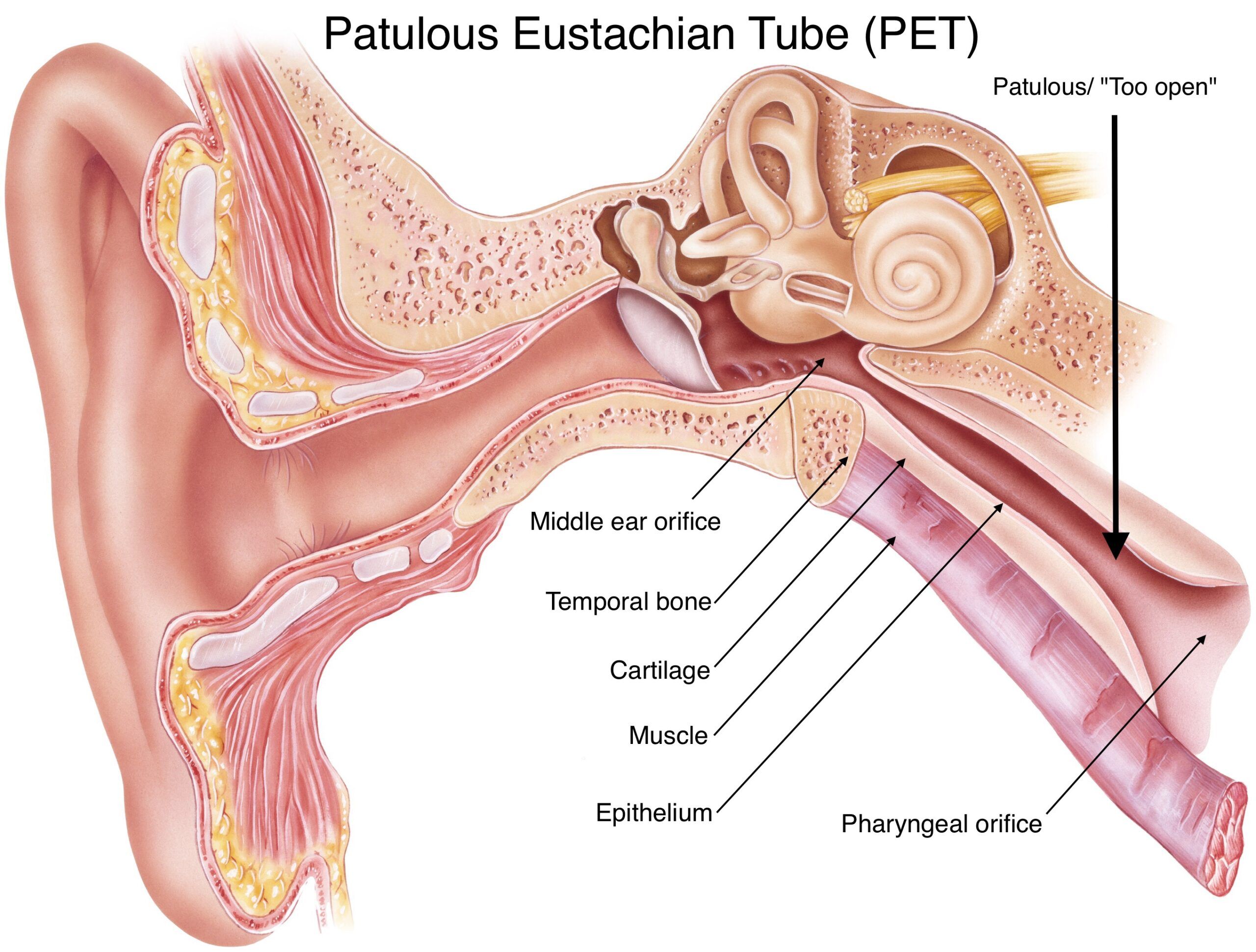 IU Tunda Konser dan Album Baru karena Patulous Eustachian Tube, Kenali Gejalanya!