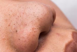 Simak Cara Aman Hilangkan Komedo Hitam di Hidung, Jangan Dipencet!