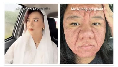 Viral! Wajah Wanita Cantik Ini Berubah Jadi Bengap Usai Hamil, Diduga Alami Kondisi Kulit Langka